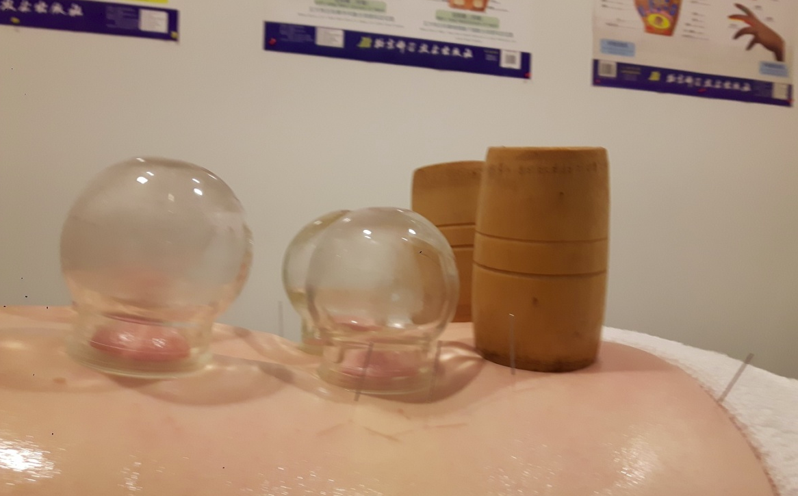 Acupuncture + Ventouses 110$